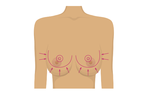 Reconstruction-mammaire